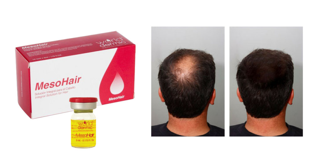 Meso Hair Professional Solution For Hair Loss — Armonia Beauty Distributor