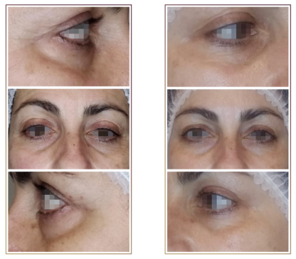 before and after dark circle electroporation
